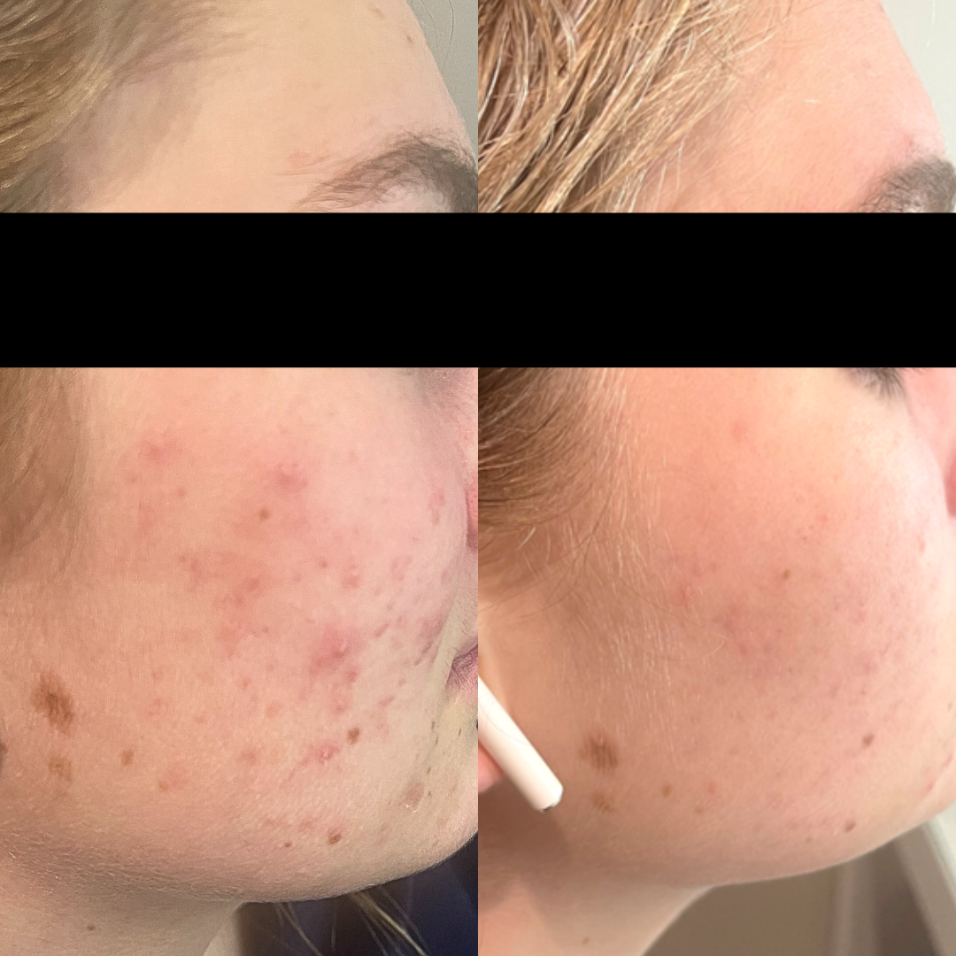 UltraClear Serum