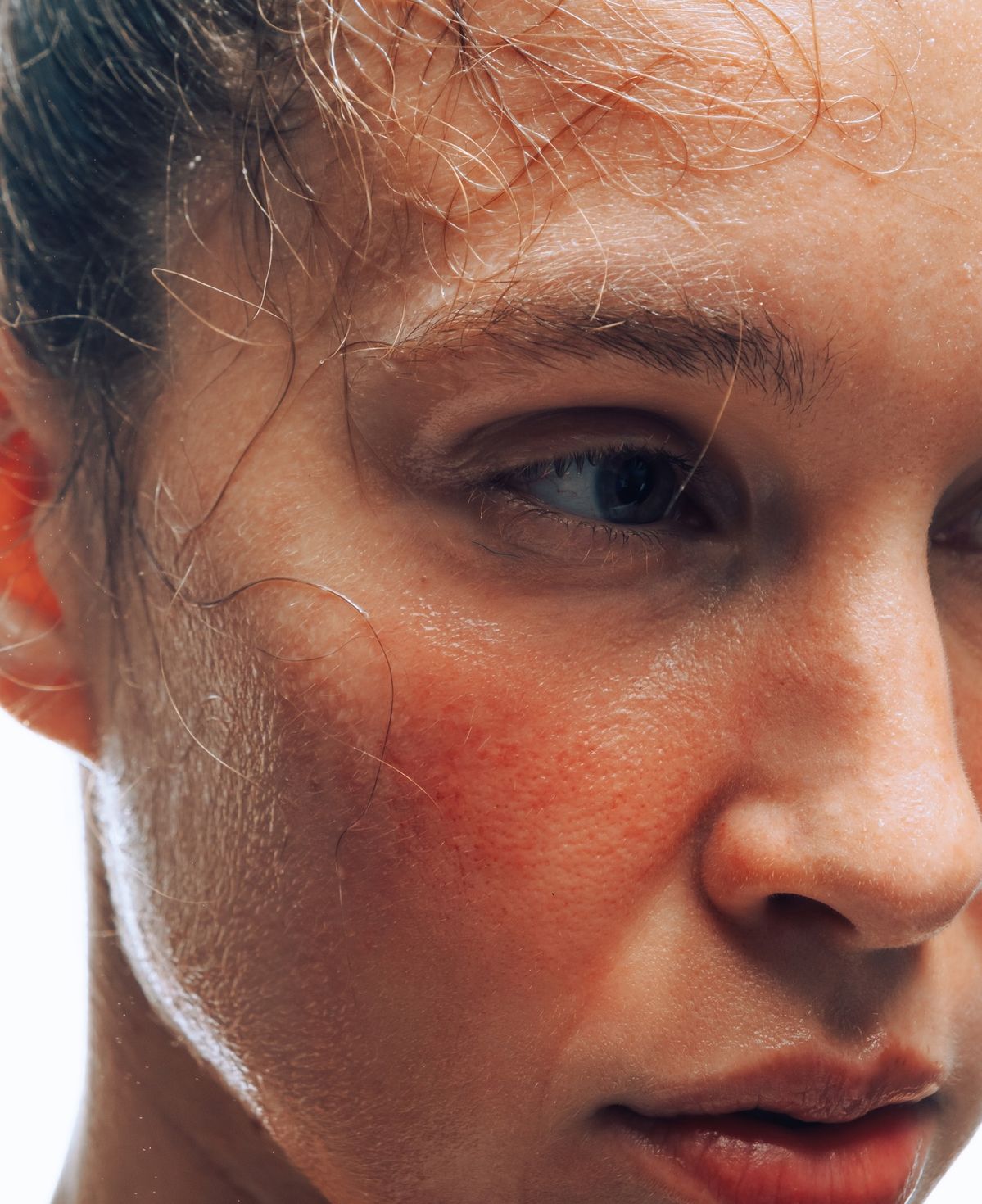 Skin Barrier Damage: Why Your Skin Suddenly Burns, Stings or Reacts