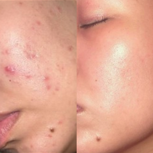 Clear Skin Bundle