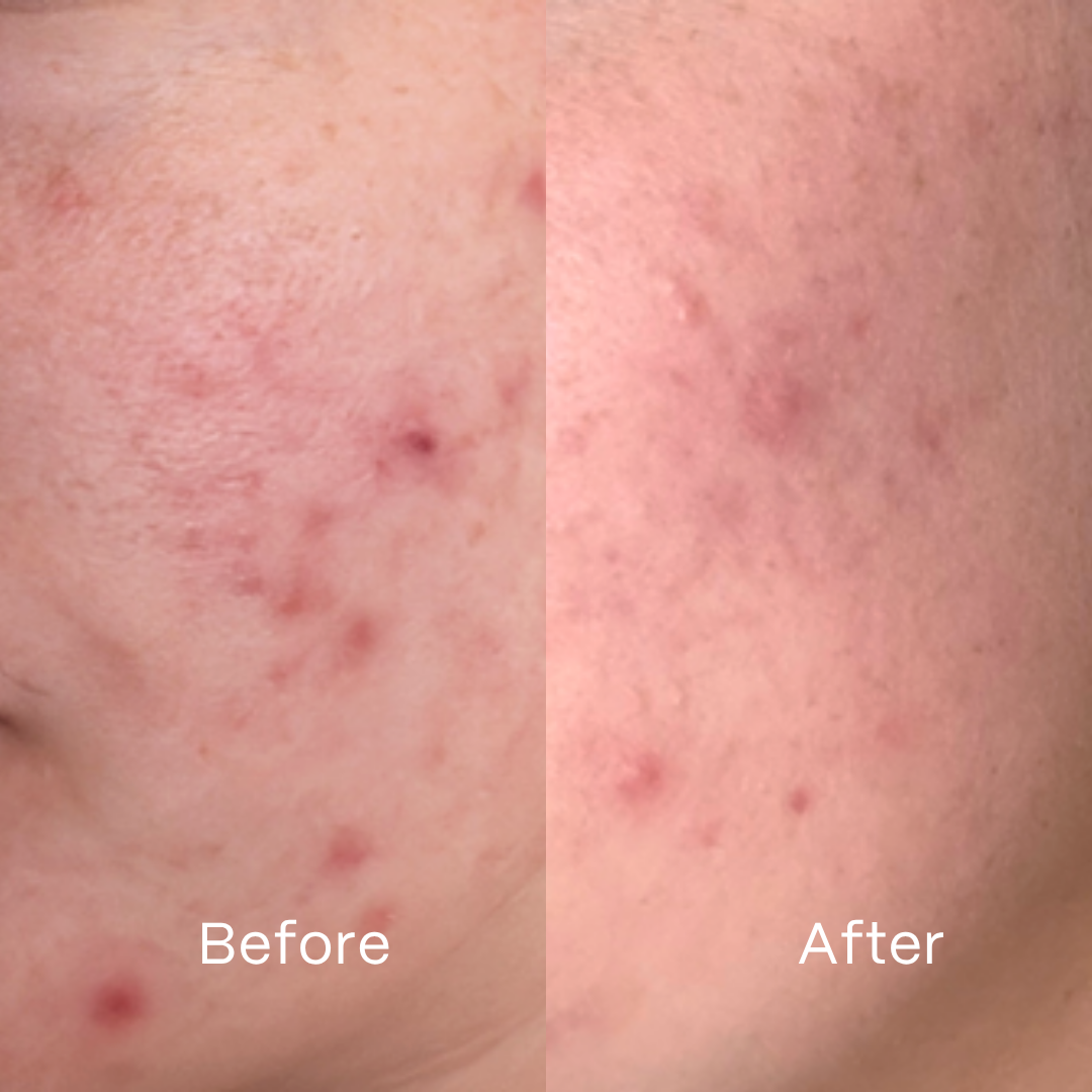Complete Clear Skin System