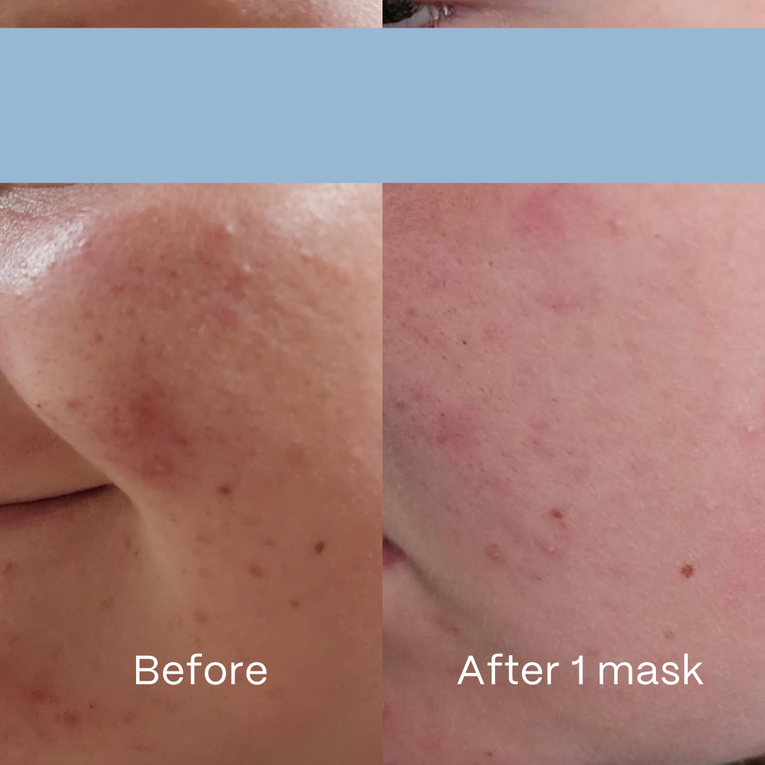 Clear Hydrogel Face Masks